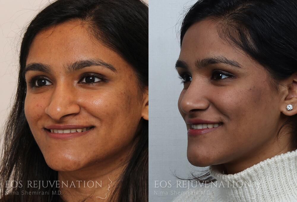 Rhinoplasty Before & After