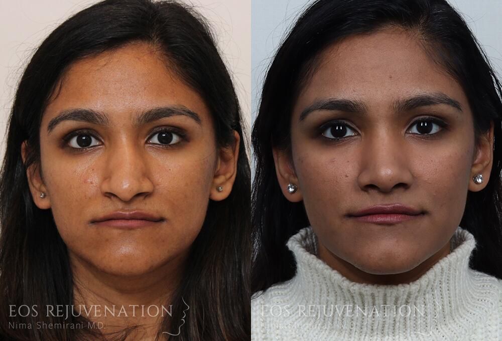 Rhinoplasty Before & After