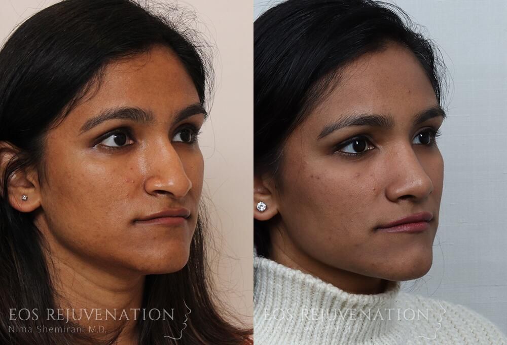 Rhinoplasty Before & After