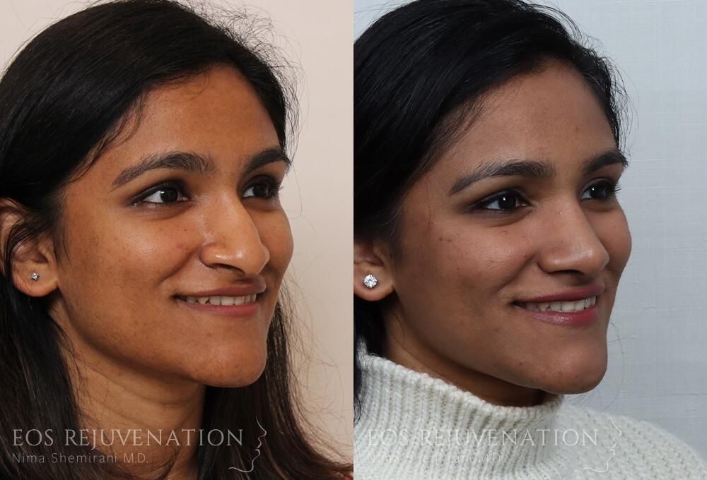 Rhinoplasty Before & After
