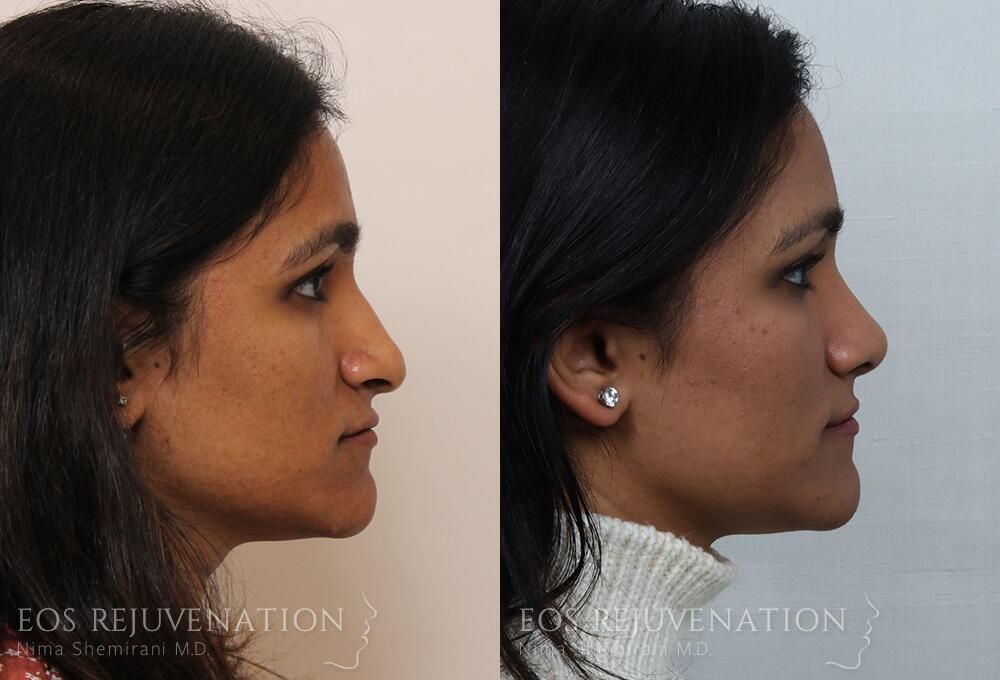 Rhinoplasty Before & After