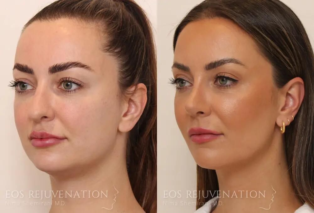Rhinoplasty Before & After
