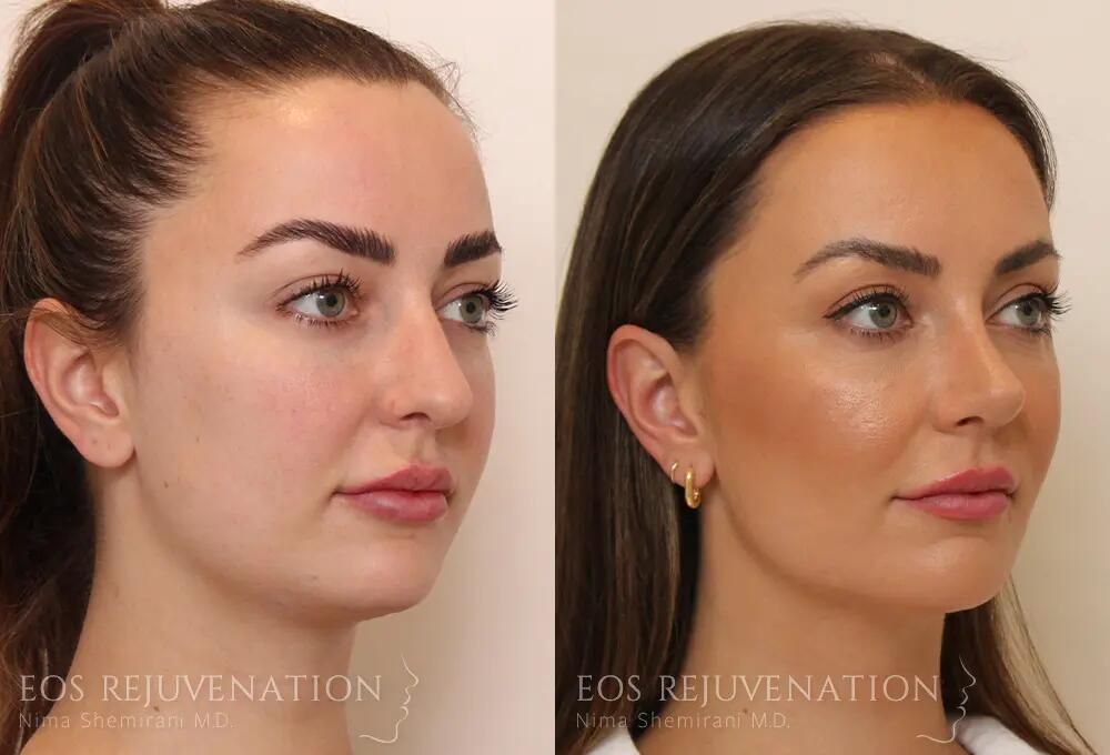 Rhinoplasty Before & After