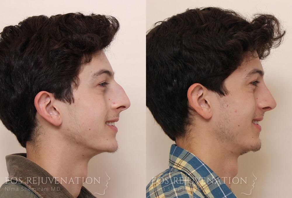 Rhinoplasty Before & After