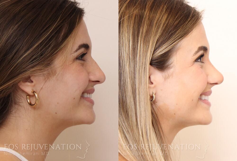 Rhinoplasty Before & After
