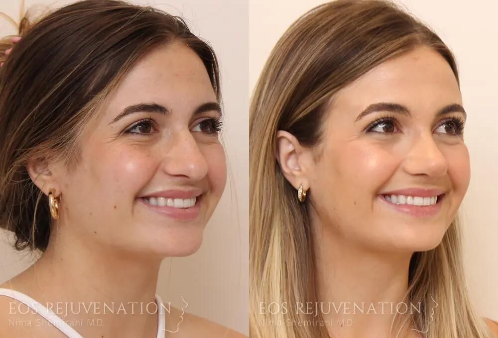 Rhinoplasty Before & After