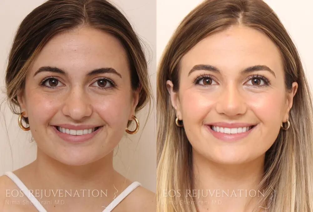 Rhinoplasty Before & After