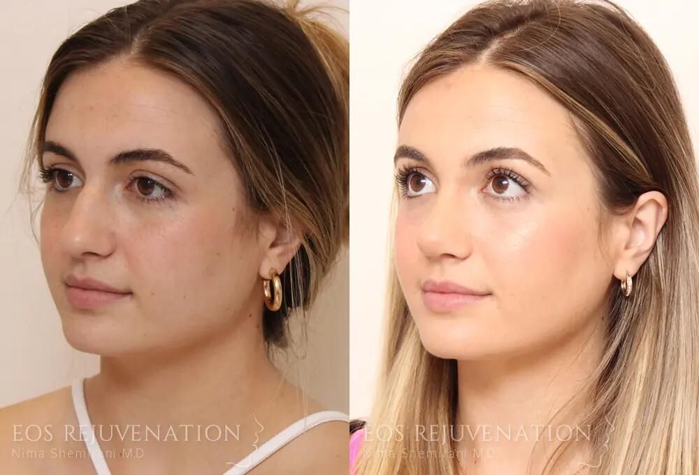 Rhinoplasty Before & After