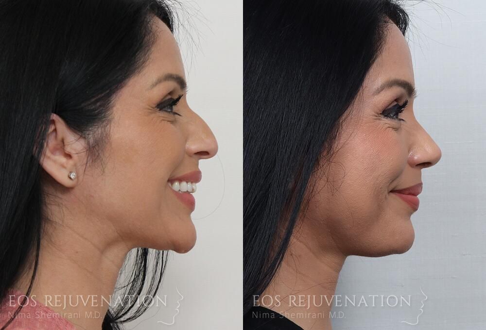 Rhinoplasty Before & After
