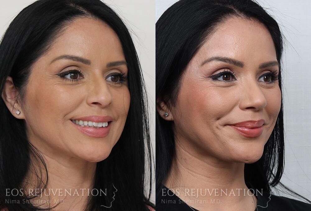 Rhinoplasty Before & After