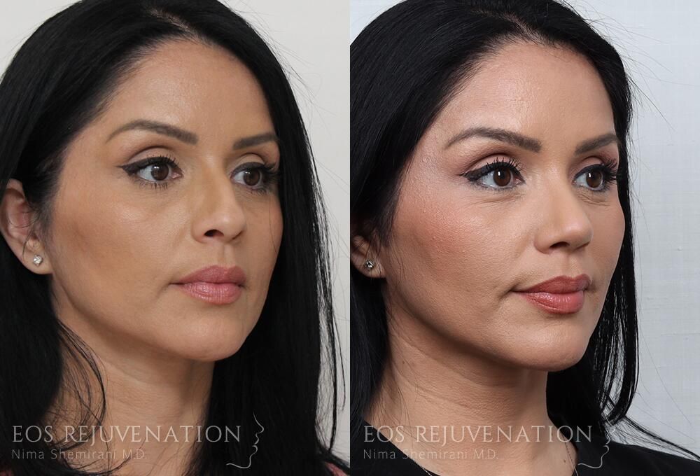 Rhinoplasty Before & After