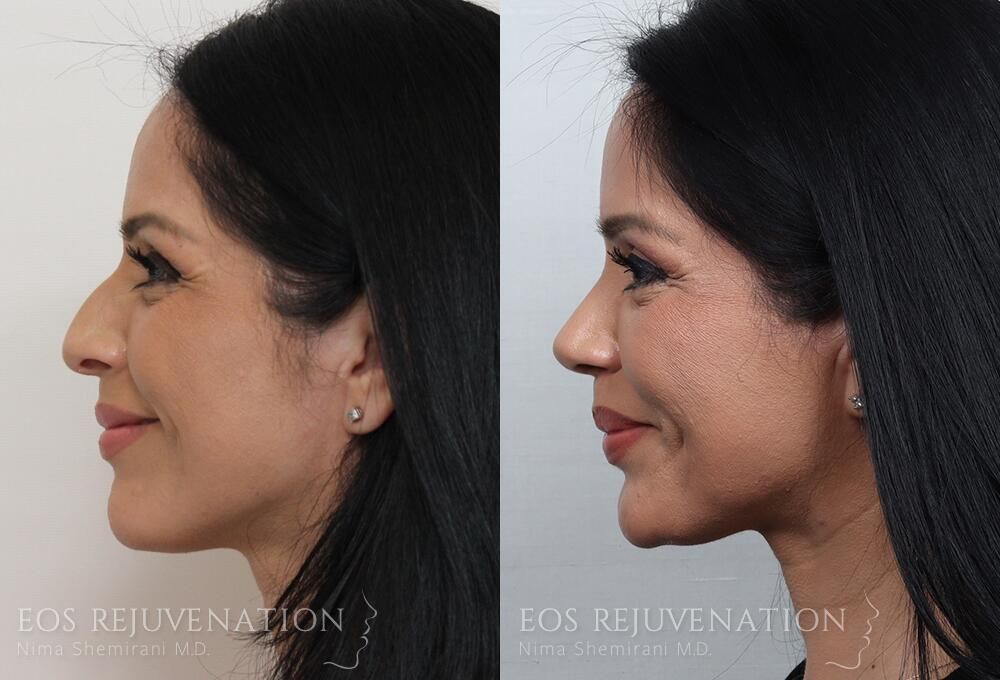 Rhinoplasty Before & After