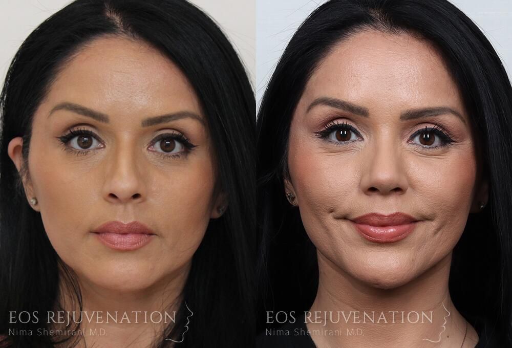Rhinoplasty Before & After
