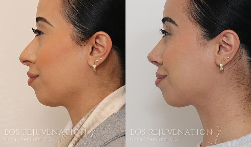 Rhinoplasty Before & After