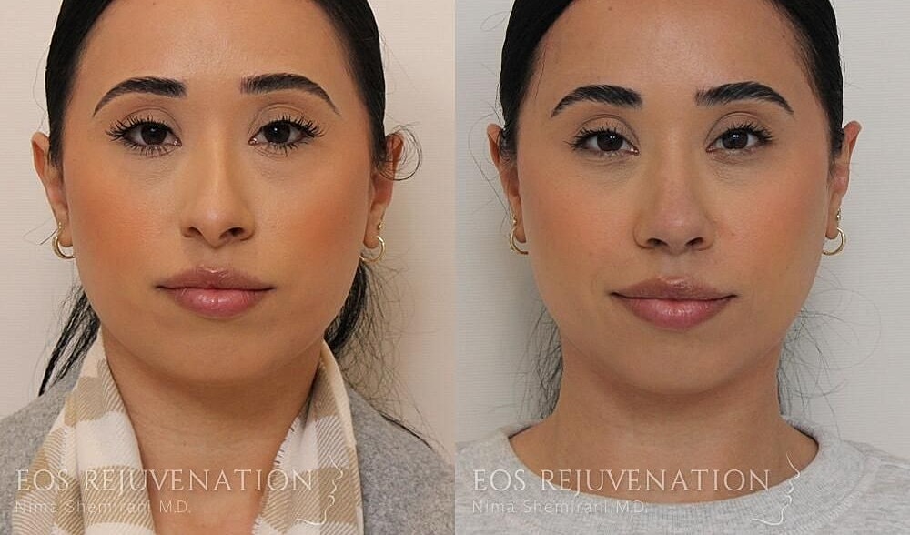 Rhinoplasty Before & After