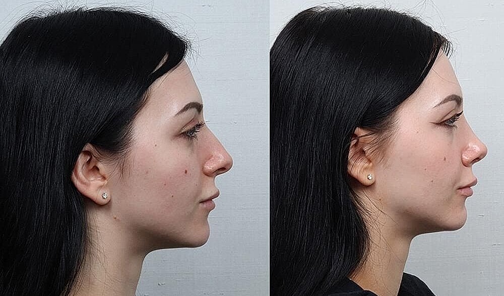 Rhinoplasty Before & After