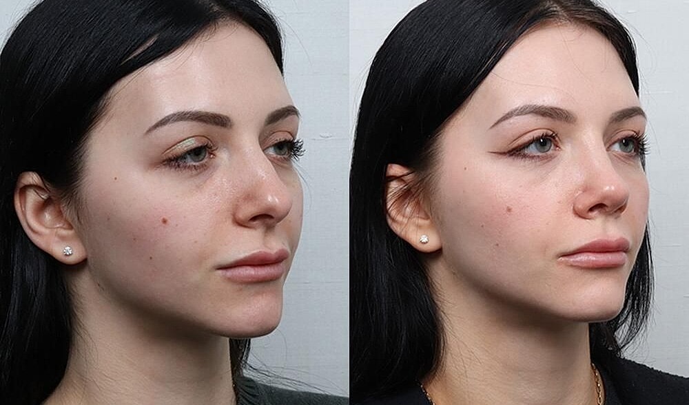 Rhinoplasty Before & After