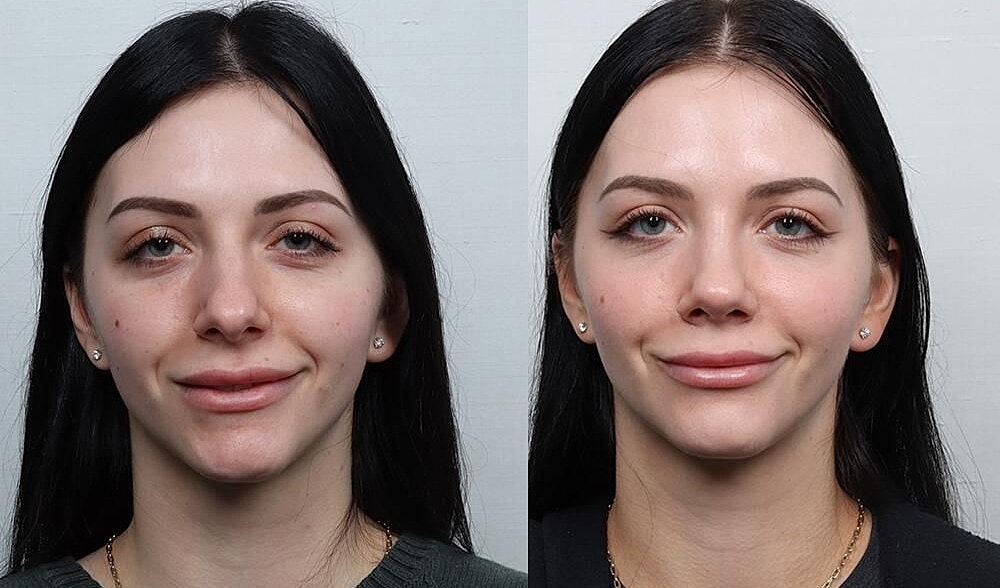 Rhinoplasty Before & After