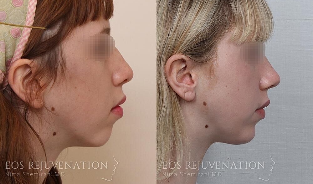 Rhinoplasty Before & After