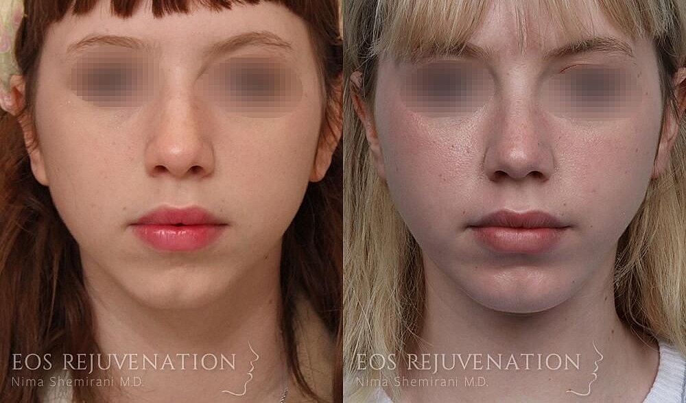 Rhinoplasty Before & After