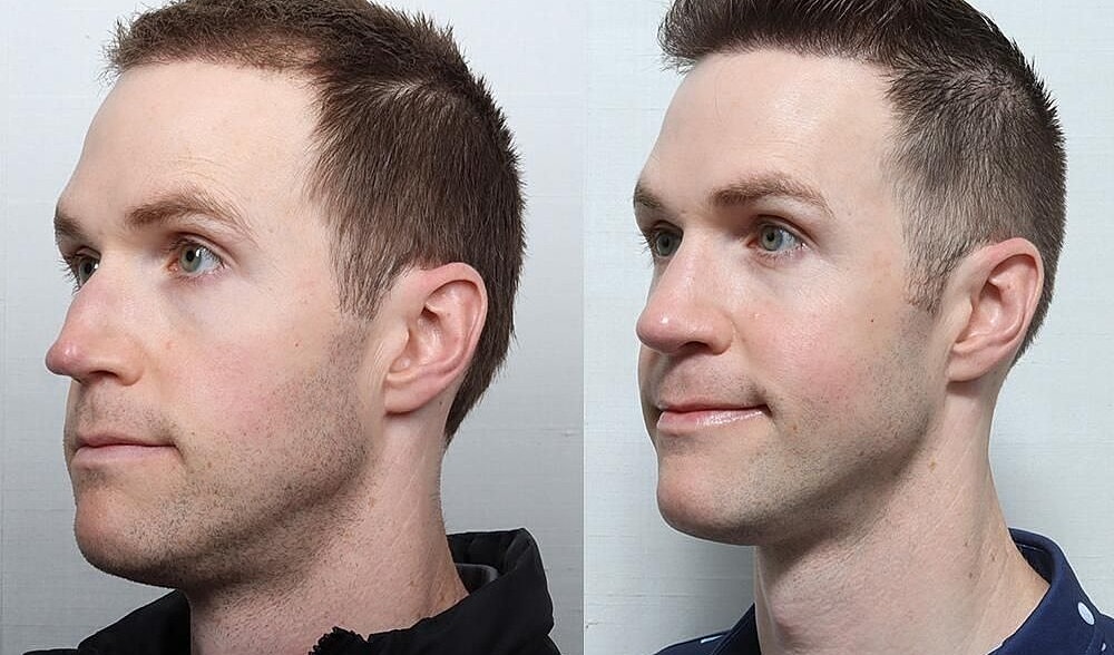 Rhinoplasty Before & After