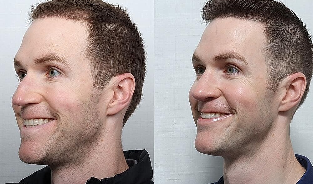 Rhinoplasty Before & After
