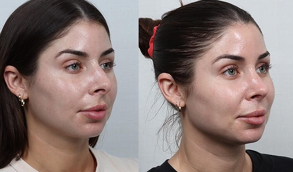 Rhinoplasty Before & After