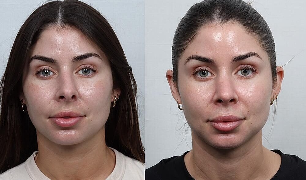Rhinoplasty Before & After