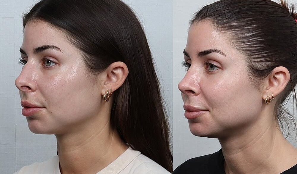 Rhinoplasty Before & After