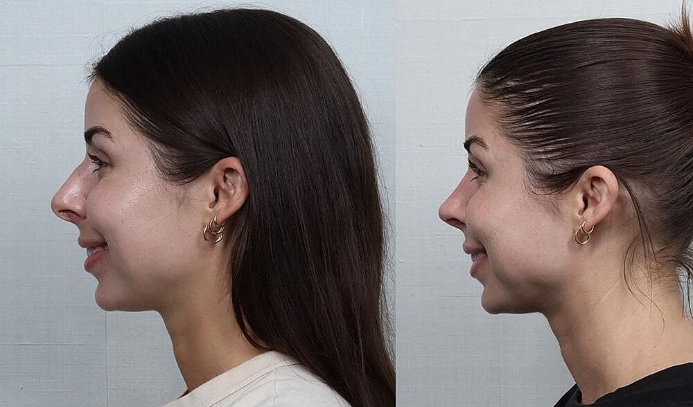 Rhinoplasty Before & After