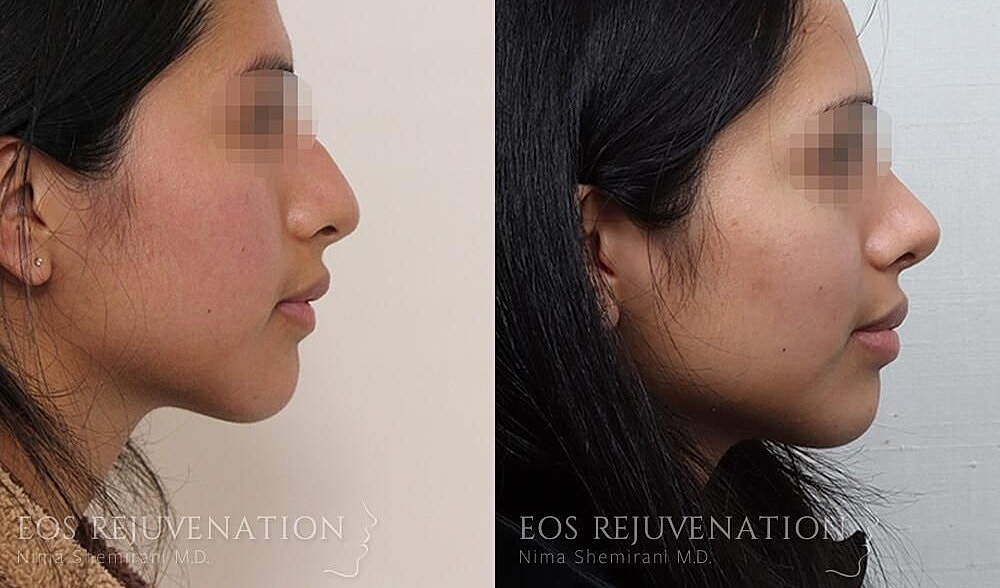 Rhinoplasty Before & After
