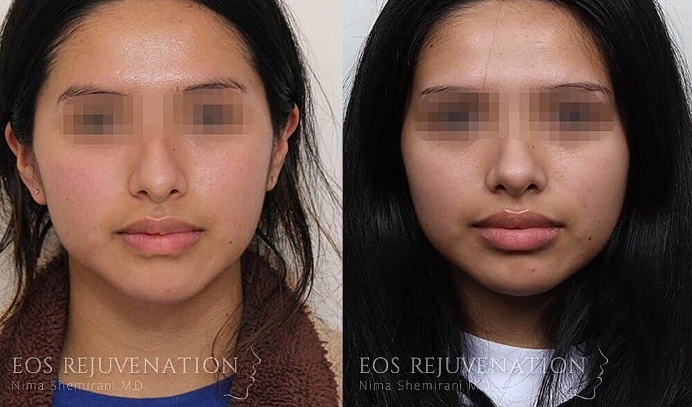 Rhinoplasty Before & After