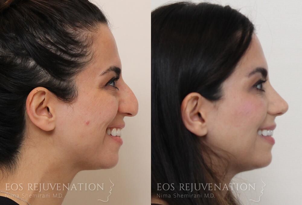 Rhinoplasty Before & After