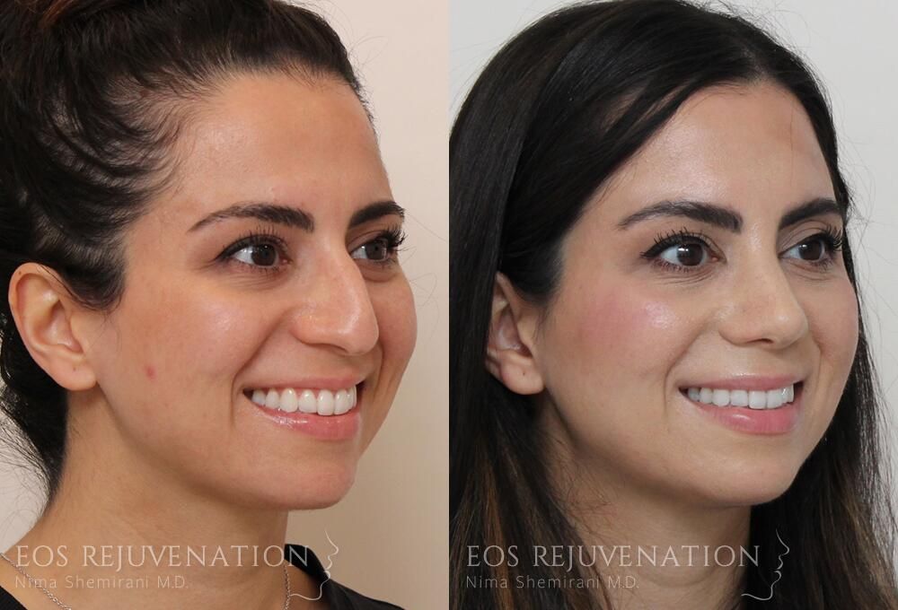 Rhinoplasty Before & After