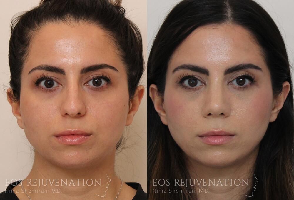 Rhinoplasty Before & After