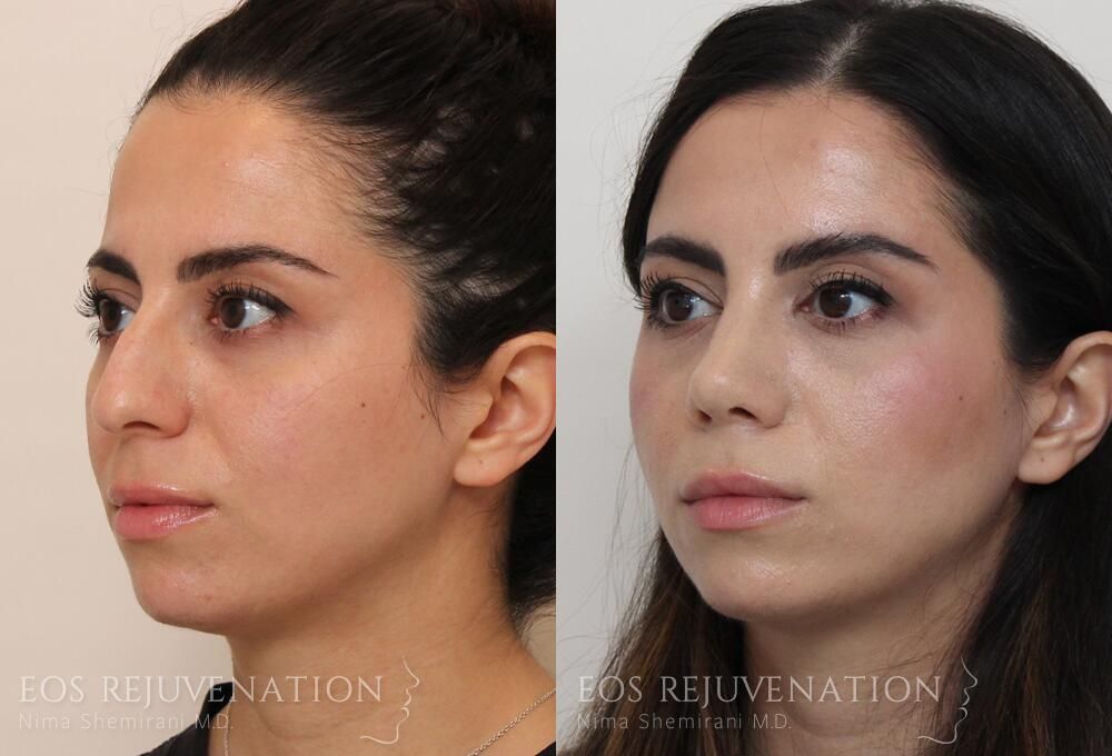 Rhinoplasty Before & After