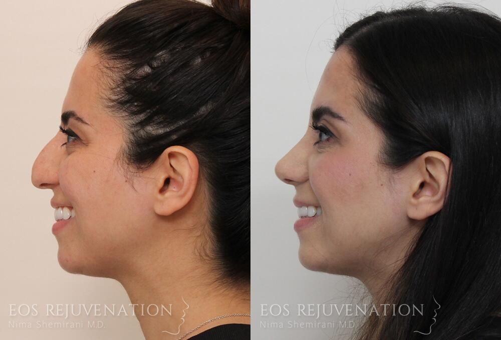 Rhinoplasty Before & After