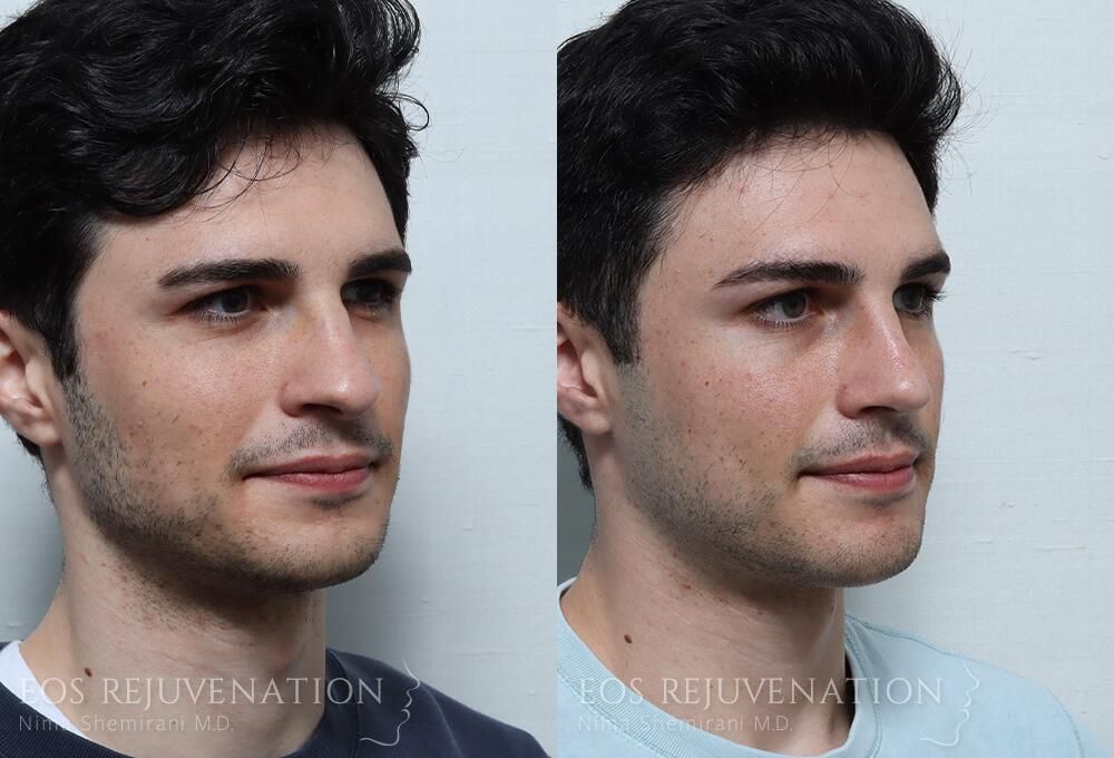Rhinoplasty Before & After