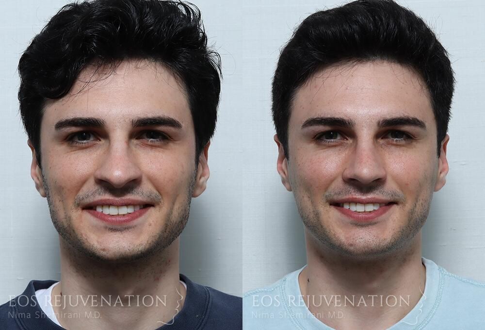 Rhinoplasty Before & After