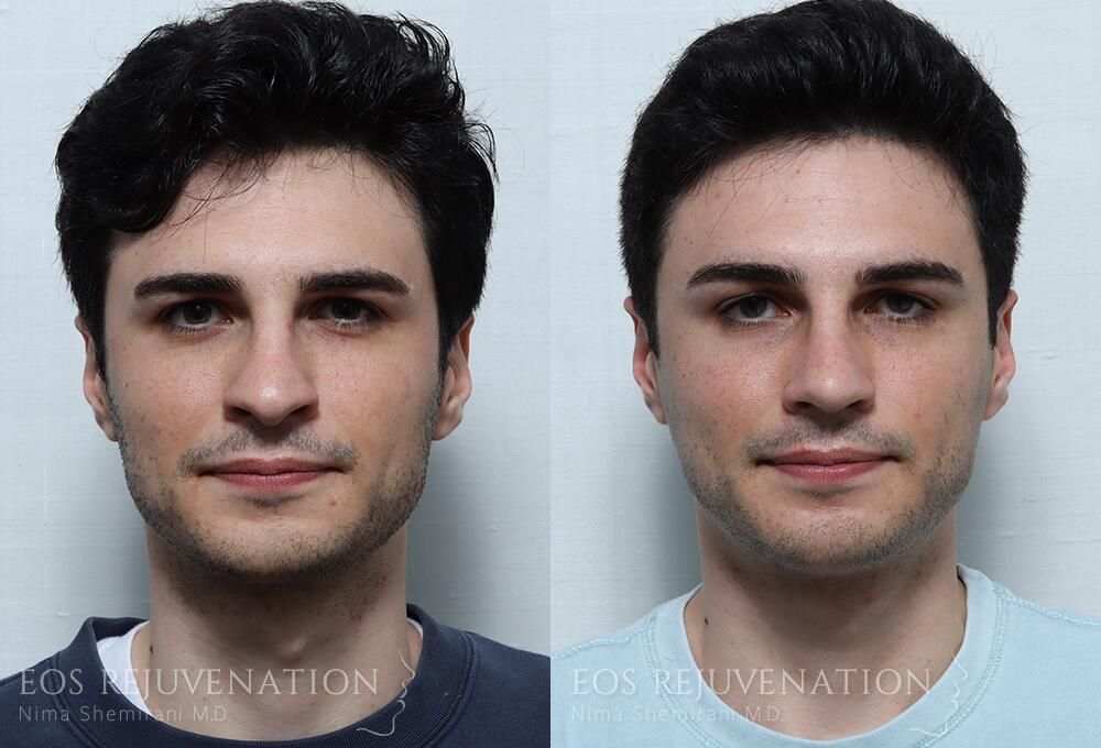 Rhinoplasty Before & After