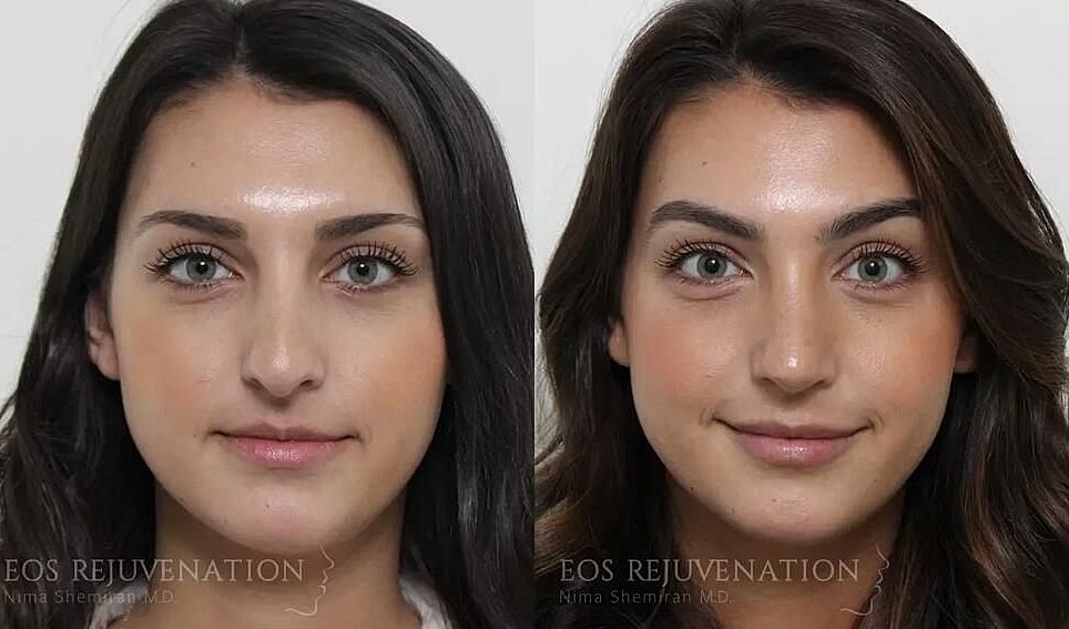 Rhinoplasty Before & After
