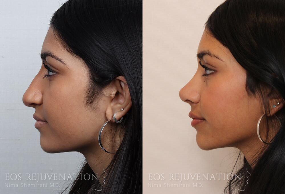 Rhinoplasty Before & After