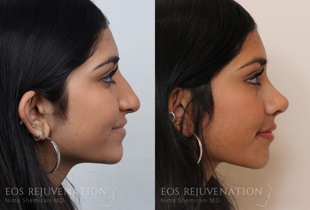 Rhinoplasty Before & After