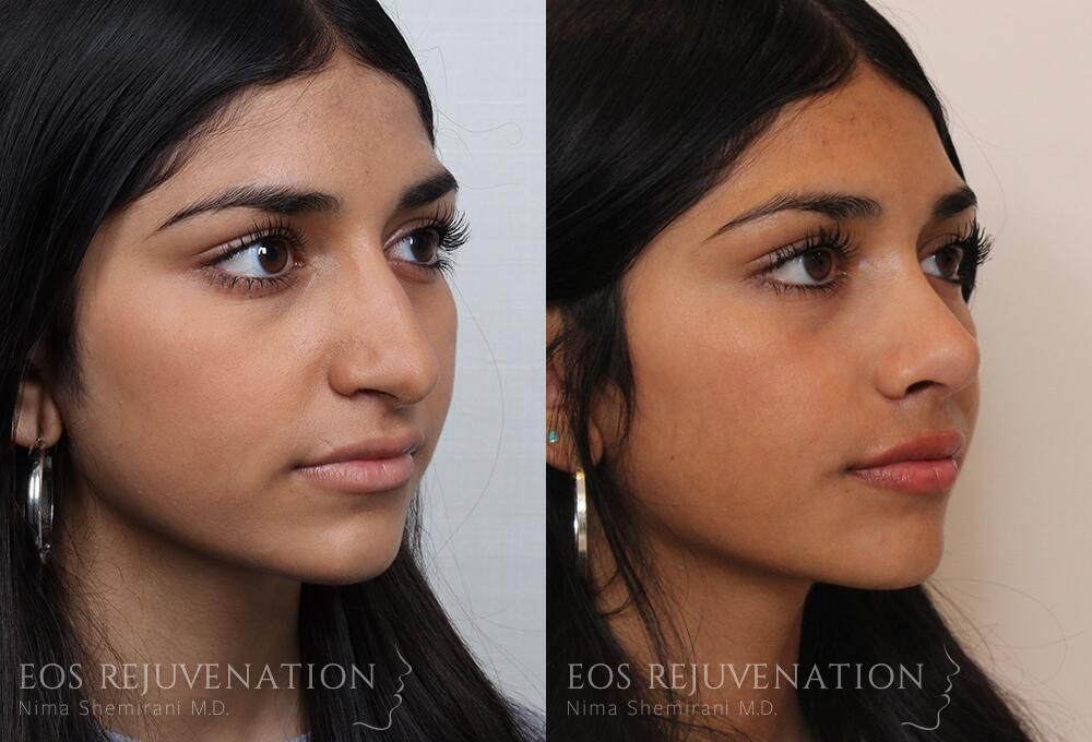 Rhinoplasty Before & After