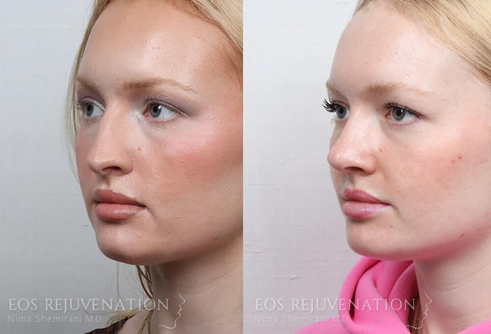 Rhinoplasty Before & After