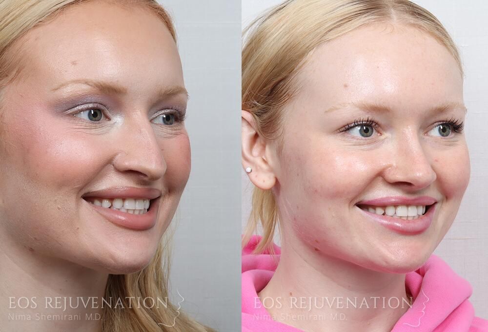 Rhinoplasty Before & After
