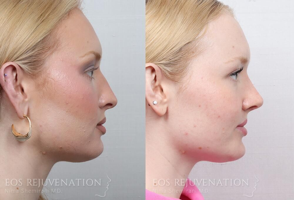 Rhinoplasty Before & After