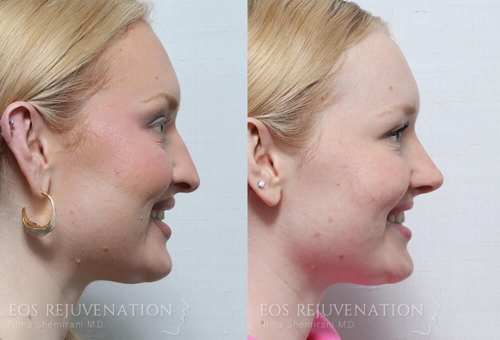 Rhinoplasty Before & After