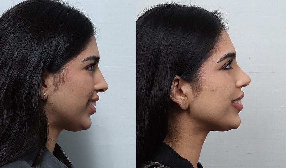 Rhinoplasty Before & After