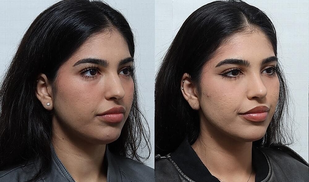 Rhinoplasty Before & After